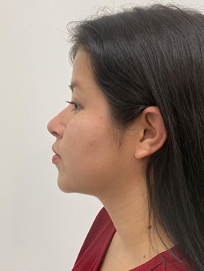 Double Chin (Submental Liposuction) After