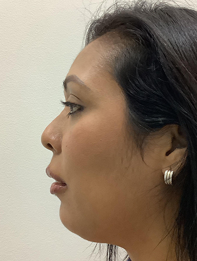Double Chin (Submental Liposuction) Before