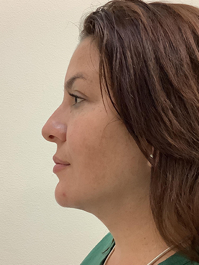 Double Chin (Submental Liposuction) After