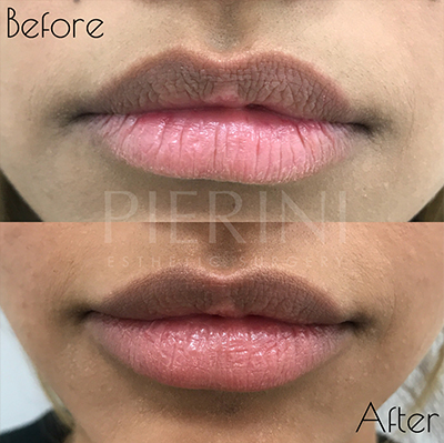 Dermal Fillers Before and After