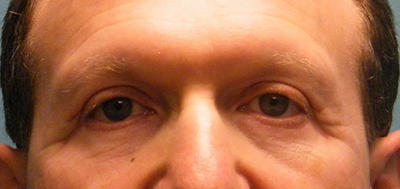 Eyelid Surgery After