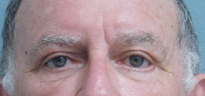 Eyelid Surgery After