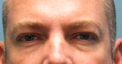 Eyelid Surgery Before