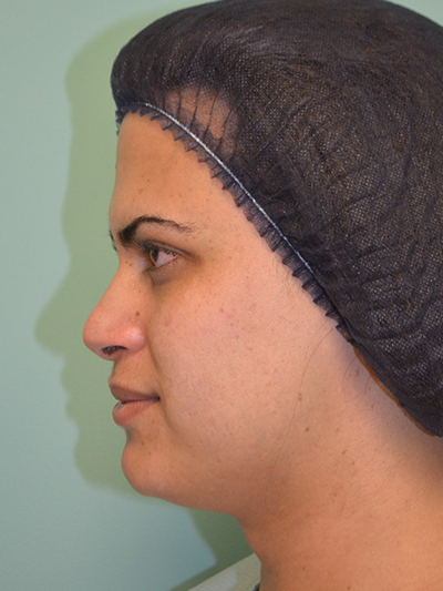 Facial Feminization Surgery Before