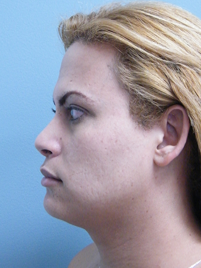 Facial Feminization Surgery After