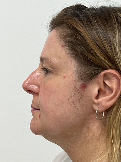 Fraxel® Laser Skin Treatment Before