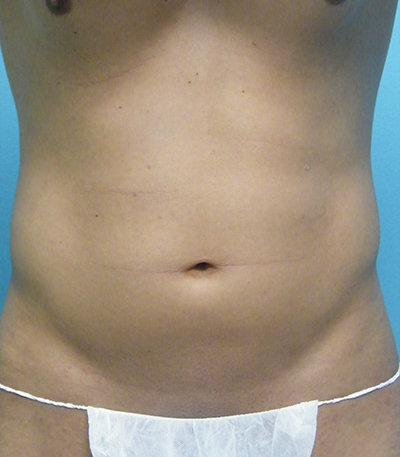 Liposuction Before