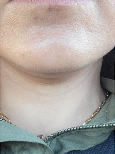 Neck Lift After