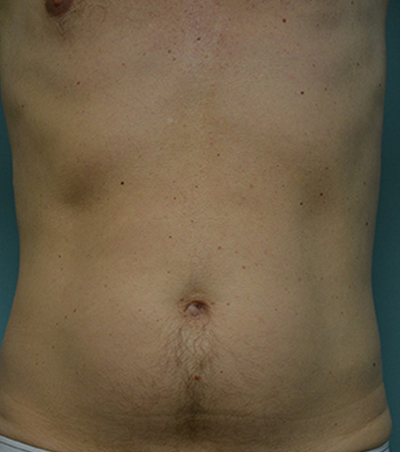 Six-Pack Abs Surgery Before