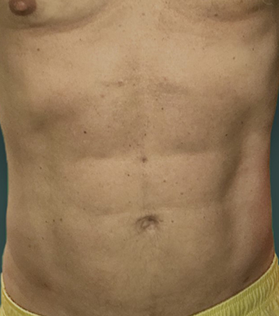 Six-Pack Abs Surgery After