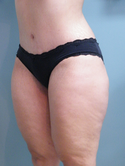 Tummy Tuck After